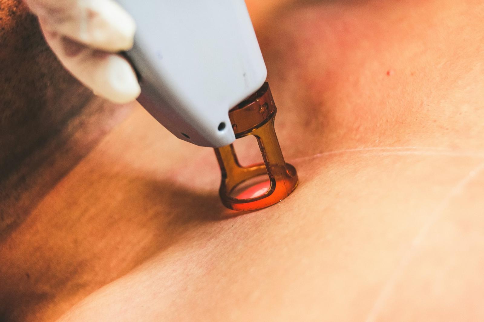 Triệt lông Diode Laser